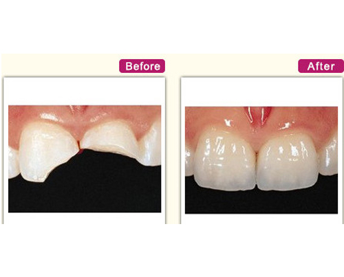 牙齿断裂全瓷牙修复