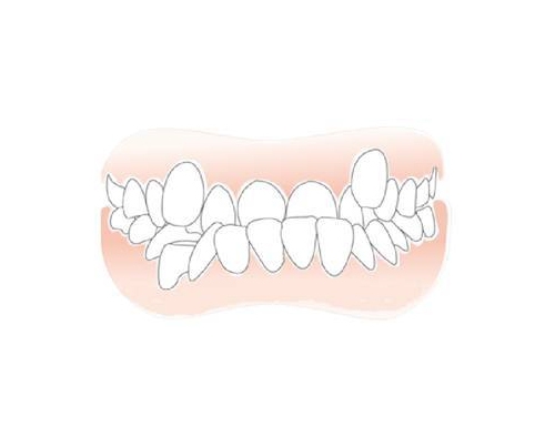 牙齿矫正