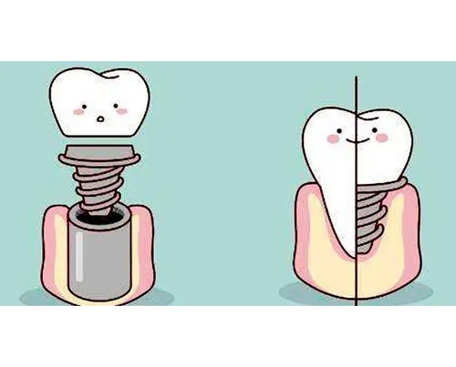 金华种植牙的优点