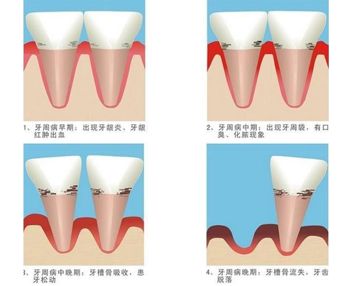 周市牙周病