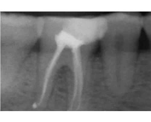 根管治疗案例